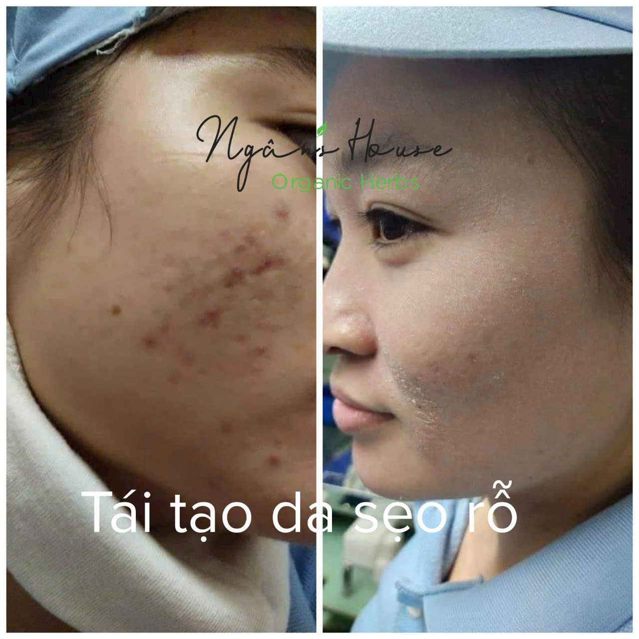 trị mụn thâm sẹo