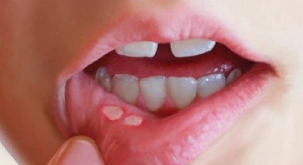 Sâu răng - Hôi miệng